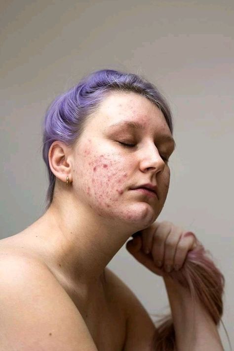 Skin Positivity, Lemon Face Mask, Acne Skincare Routine, Normal Body, Women Skin, Body Positive, Beauty Standards, Photo Series, Skin Issues