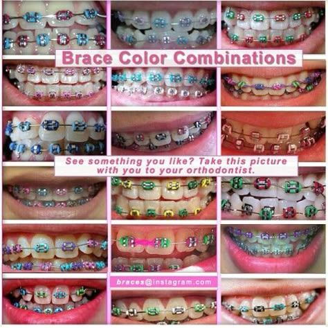 Color combinations Rainbow Braces, Braces Colors Combinations, Invisible Teeth Braces, Permanent Retainer, Pink Braces, Braces Retainer, Natural Teeth Whitening Diy, Cute Braces Colors, Braces Tips