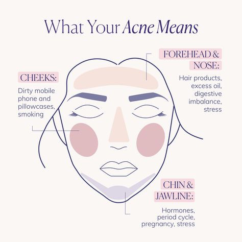 What Causes Pimples, Face Mapping Acne, Blind Pimple, Pimples Under The Skin, Skin Facts, Skin Advice, Face Mapping, Prevent Pimples, Natural Acne Remedies