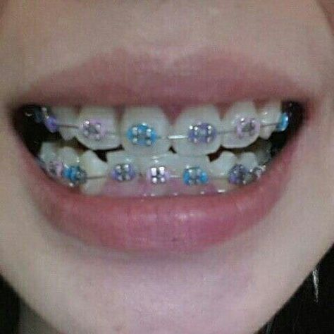 Light Blue Braces Teeth, Purple And Blue Braces, Braces Light Blue, Pink And Blue Braces, Violet Braces, Light Purple Braces, Sky Blue Braces, Lilac Braces, Star Braces