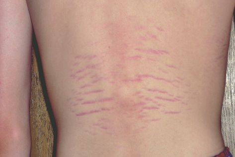 Bartonella Symptoms - Tired of Lyme Bartonella Symptoms, Types Of Ticks, Lower Abdominal Pain, Rash Causes, Varicose Vein Removal, Tick Bite, Allergy Awareness, Abdominal Pain, Alternative Medicine