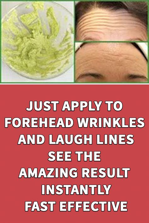 Remove Forehead Wrinkles, Natural Wrinkle Remedies, Mouth Wrinkles, Anti Aging Remedies, Wrinkle Remedies, Wrinkle Free Skin, Erase Wrinkles, Laugh Lines, Forehead Wrinkles