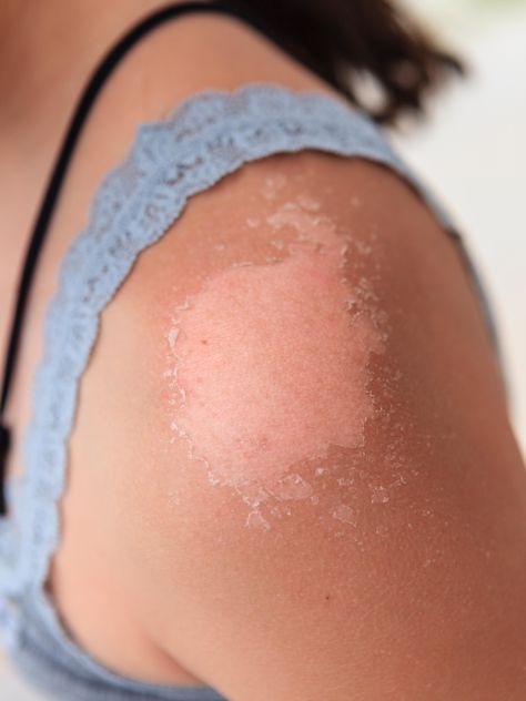 Why Your Skin Peels After a Sunburn, According to Dermatologists | Allure Sunburn On Face, Sunburn Peeling, Sunburn Skin, Sunburn Remedies, Face Peel, Sun Burn, Peeling Skin, Lint Roller, Skin Remedies