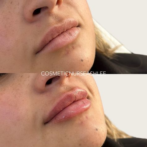 Another lip filler before and after 🧚🏼🫶🏼 Today our goals were to 1. add some PLUMP hydration💦 and 2. Work on symmetry, as one of the GK points (an arch of the cupids bow) was just sliiightly 👌 higher than the other. A common concern a lot of people have with both natural lips, and previously filled lips. What do you think? 🤭 Personally I’m obsessed 😍 @cosmeticnurseashlee *swelling will subside over a few days. — Results vary between individuals. All injectable treatments require a co... Filled Lips, Lip Filler, Cupids Bow, Lip Fillers, A Lot Of People, Natural Lips, You Think, Thinking Of You, Arch