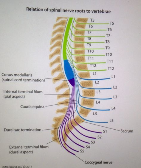 Cauda Equina Syndrome... Occurs due to compression of SPINAL NERVE ROOTS... Radiculopathy (sharp pain that radiates) + progressive difficulty with urination + Saddle region parasthesias + Lower Extremity weakness more pronounced on one side + Hyporeflexia + decreased sphincter tone... Managed with neurosurgical decompression and IV Steroids... Conus Medularis Syndrome will have acute onset bladder dysfunction + bilateral weakness + Hyperreflexia Spine Anatomy, Cauda Equina, Spinal Nerve, Tight Hip Flexors, Lower Extremity, Spine Health, Psoas Muscle, Sciatic Nerve Pain, Human Anatomy And Physiology