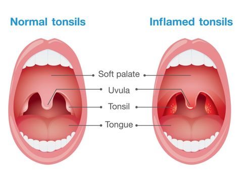 Remedies For Tonsillitis, Swollen Tonsils, Headache Relief Instant, Throat Remedies, Soft Palate, Throat Infection, Natural Headache Remedies, Holistic Remedies, Headache Relief