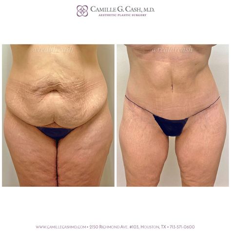 Lower Body Lift Surgery, Lower Body Lift Surgery Before And After, Tummy Tucks Before And After, Body Lift Surgery, Tummy Tucks Recovery, Mommy Makeover Surgery, Lap Band, Excess Skin, Mommy Makeover