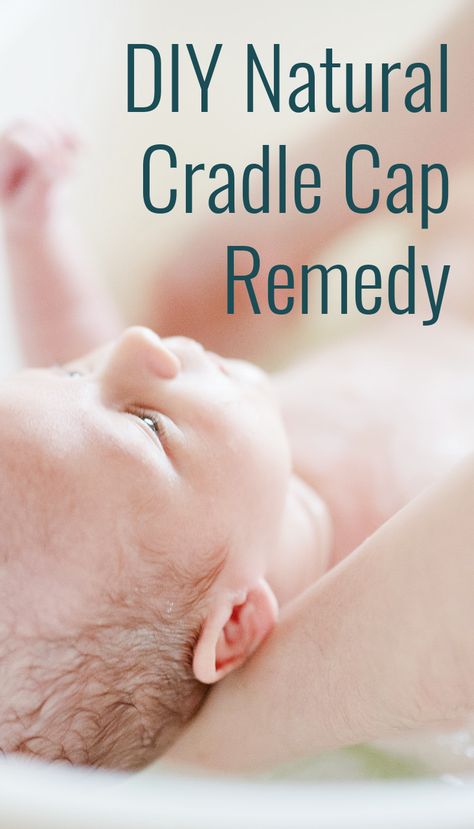 Learn how to get rid of cradle cap naturally with this DIY natural cradle cap remedy! Odds are you have it in your kitchen already! Baby Craddle, Cradle Cap Remedies, Natural Kids, Natural Teething Remedies, Popular Skin Care Products, Eco Kids, Essential Oils For Pain, Cradle Cap, Eco Baby