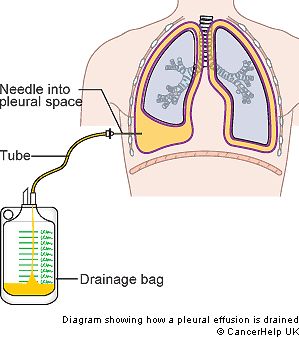 M.Tb pleural effusions show ALL lymphocytes and NO mesothelial cells. Classic. Nurse Skills, Nurse Teaching, Pleural Effusion, Nurse Training, Nursing Mnemonics, Respiratory Therapy, Nursing Tips, Nursing Career, Travel Nursing