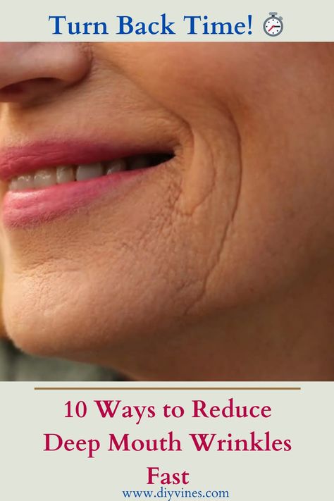 10 Ways to Reduce Deep Mouth Wrinkles Fast Deep Wrinkles Around Mouth, How To Get Rid Of Frown Lines By Mouth, How To Get Rid Of Laugh Lines, Dry Mouth Remedies How To Get Rid, How To Get Rid Of Wrinkles, Frown Lines Around Mouth, Wrinkles Around Mouth, Lines Around Mouth, Upper Lip Wrinkles