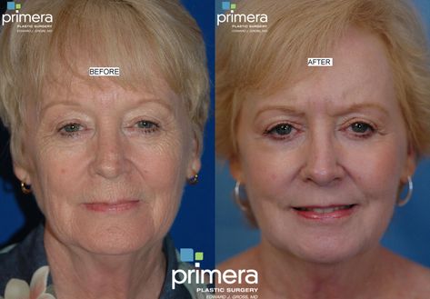 Phenol Peel Before And After, Chemical Peel Before And After, Phenol Peel, Miami Winter, Laser Skin Resurfacing, Botox Cosmetic, Eyelid Lift, Facial Plastic Surgery, Skin Resurfacing