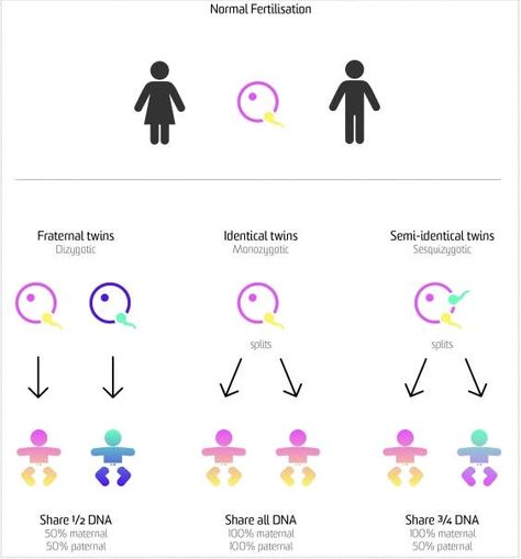 A diagram illustrating the different types of twins Types Of Twins, Pregnant With Boy, Development Milestones, Dna Genealogy, Fraternal Twins, Expecting Twins, Human Anatomy And Physiology, Smart Parenting, Medicine Journal