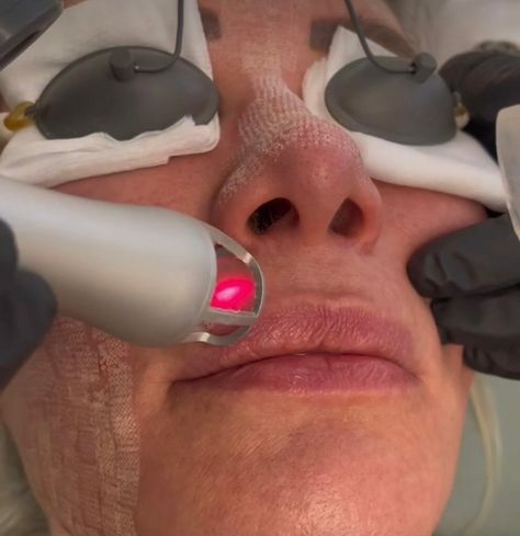 5 Benefits of CO2 Laser Resurfacing at Bryn Mawr Dermatology Cosmetic Laser Skin Treatments, Laser Resurfacing Before And After, Fractional Laser Before After, Anatomy 101, Face Laser, Laser Facial, Laser Skin Resurfacing, Fractional Laser, Laser Resurfacing