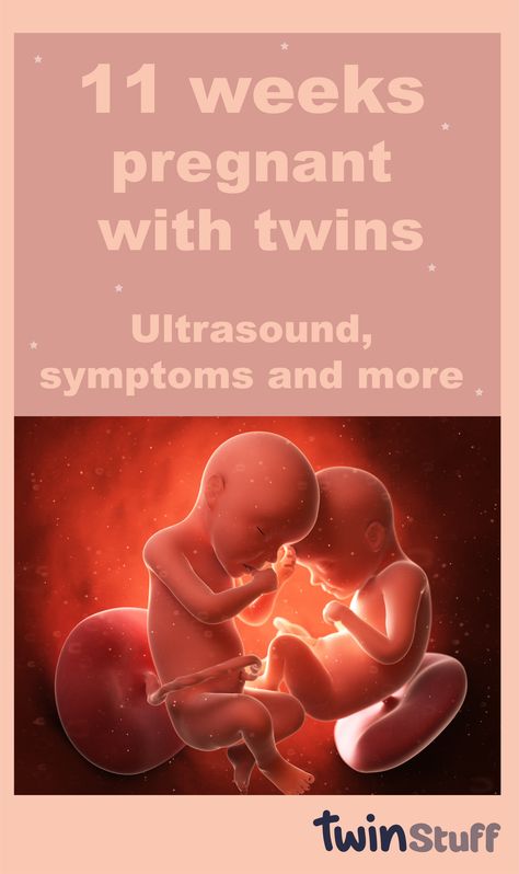 11 Weeks Pregnant Ultrasound, 10 Weeks Pregnant Ultrasound, 11 Weeks Pregnant Belly, Pregnant With Twins Belly, Pregnancy Step By Step, Twins Belly, Twin Pregnancy Symptoms, Twins Ultrasound, Twin Belly