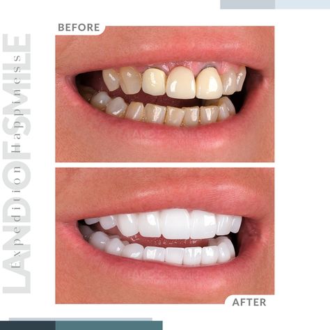 In just one session, we closed gaps with bridge techniques for a missing back tooth and replaced old crowns. The gums were realigned to create a balanced look. The Hollywood smile was achieved with a natural design. We completed the bright, white teeth in just 5 days using e.max® Prime Zirconium Crowns with CAD/CAM technology 🥰 #landofsmiletr #dentaltreatmentturkey #smilemakeoverturkey #emax #veneers #turkeyteeth #dentalcareturkey #dentaltravel #dentalclinicturkey #dentalclinic #dentalcenter... Hollywood Smile Teeth, Emax Veneers, Hollywood Smile, Teeth Design, Veneers Teeth, Dental Center, Smile Teeth, Smile Makeover, Cad Cam