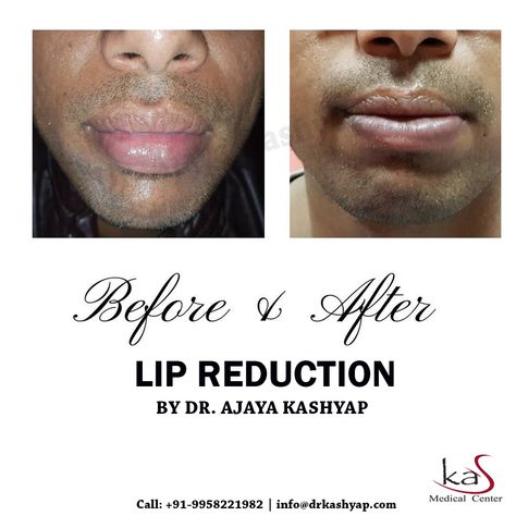 Lip Reduction, Thick Lips, Lip Surgery, Face Surgery, Face Lift Surgery, Reduction Surgery, Nose Surgery, Lip Cosmetics, Breast Reduction