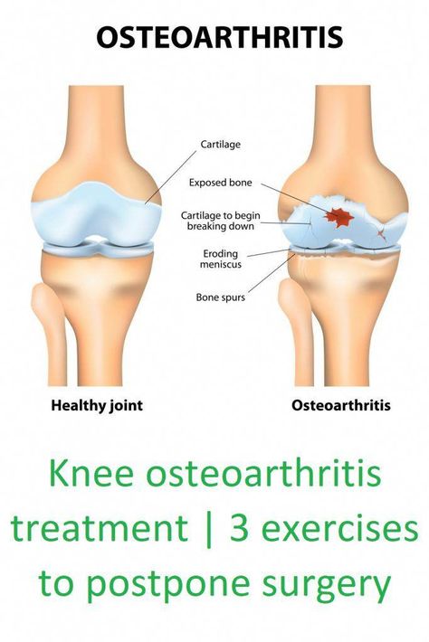 Exercises For Arthritic Knees, Knee Replacement Exercises, Knee Pain Stretches, Knee Pain Relief Remedies, Knee Pain Relief Exercises, Knee Pain Remedy, Swollen Knee, Knee Strengthening Exercises, Knee Pain Exercises