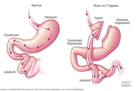 Dumping syndrome - Symptoms and causes - Mayo Clinic Bile Reflux, Dumping Syndrome, Gastric Problem, Gastric Juice, Sleeve Gastrectomy, Abdominal Surgery, Types Of Surgery, Bypass Surgery, Reflux Disease