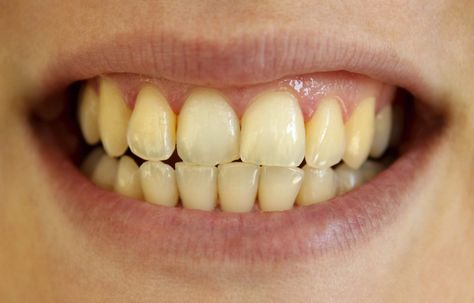 Whiten Teeth Fast, Teeth Whitening Remedies, Whiter Teeth, Yellow Teeth, Stained Teeth, Natural Teeth Whitening, Whitening Toothpaste, Men's Health, White Teeth