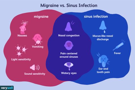 Migraine and Sinus Headache: How to Tell the Difference Remedy For Sinus Congestion, Types Of Migraines, Home Remedies For Sinus, Headache Causes, Throbbing Headache, Migraine Headache, How To Relieve Nausea, Eye Pain, Sinus Headache