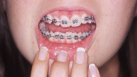 5 Things to Know About comfort denal braces. We offer all types of dental braces for teeth like transparent braces, ceramic braces, metal braces and more for greater comfort and high quality results. Know More Today! Transparent Braces, Arm Lift Surgery, Damon Braces, Gold Braces, Ceramic Braces, Braces Cost, Adult Braces, Dental Retainer, Invisalign Braces