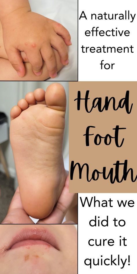 Hand Foot And Mouth Disease Remedies, Mouth Blisters, Hand Foot And Mouth Disease, Back Pain Massage, Herbal First Aid, Healing Spices, Tooth Health, Nutritional Healing, Herbal Facial