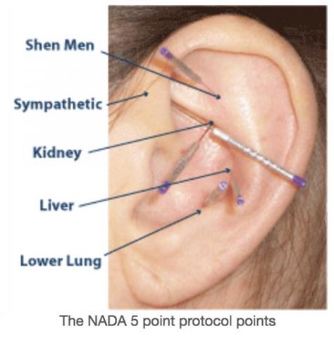 Nada Protocol, Auricular Acupuncture, Ear Acupressure, Ear Reflexology, Acupuncture Benefits, Ink Link, Acupuncture Points, Acupressure Points, Traditional Chinese Medicine