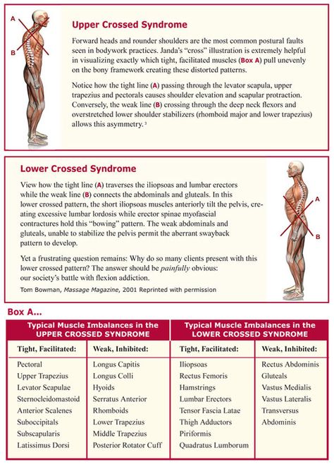 Upper and Lower Crossed Syndrome Upper Cross Syndrome, Fact Or Fiction, Chronic Fatigue Symptoms, Musculoskeletal Pain, Muscle Anatomy, Medical Anatomy, Massage Benefits, Healing Therapy, Anatomy And Physiology