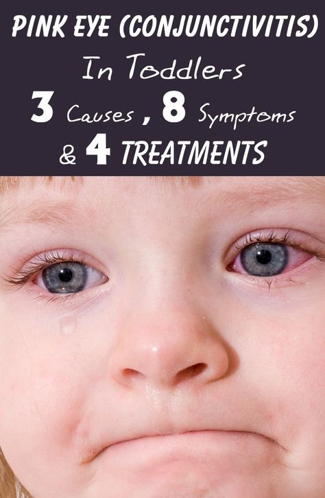 Pink Eye (Conjunctivitis ) In Toddlers - 3 Causes, 8 Symptoms & 4 Treatments You Should Be Aware Of Pink Eye In Toddlers, Pink Eye Remedies, Pink Eye Remedy, Goopy Eyes, Treating Pink Eye, Pink Eye Home Remedies, Natural Pink Eye Remedy, Pinkeye Remedies, Mommy Ideas