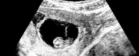 Is The 'Fetal Heartbeat' Detected at 6 Weeks Actually a Heartbeat? A Doctor Explains 6 Week Baby, Early Pregnancy Signs, Heart Muscle, Baby Heartbeat, Cleveland Clinic, Health Research, Pregnancy Signs, Circulatory System, Trimesters Of Pregnancy