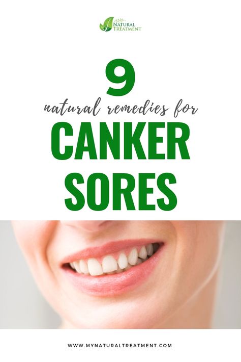 Sore Gums Remedy, Canker Sore On Tongue, Gum Sores, Canker Sore Remedy, Tongue Sores, Mouth Health, Canker Sore, Amazing Home, Natural Treatments