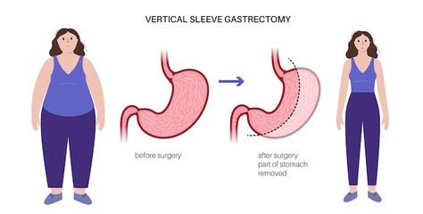 Vertical sleeve gastrectomy laparoscopy ... | Premium Vector #Freepik #vector #gastric-sleeve #gut #bariatric-surgery #digestion Vertical Sleeve Gastrectomy, Sleeve Gastrectomy, Sleeve Surgery, Premium Vector, Surgery