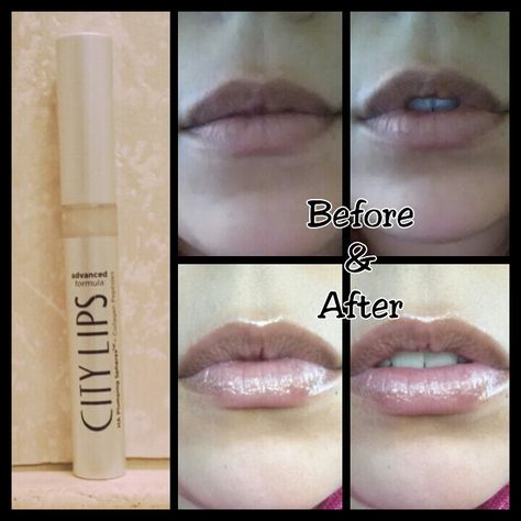 City Lips Before & After Photos City Lips Before And After, Pharmacy Compounding, Diy Lip Plumper, Bjd Head, Jlo Hair, Lip Plumpers, City Lips, Cosmetics Store, Luxury Cosmetics