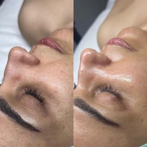 Oxygen Facial Before And After, Before And After Facial Pictures, Facial Care Aesthetic, Facial Aesthetics Skin Care, Facial Pictures, Skin Care Pictures, Oxygen Facial, Microcurrent Facial, Spa Facial