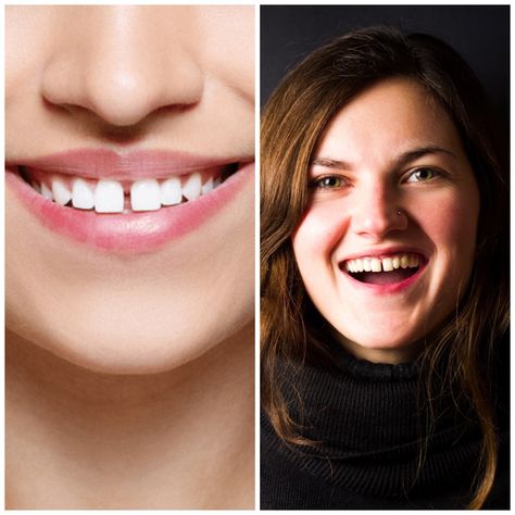 Home Remedies for Gap between Teeth How To Get Rid Of Gaps In Teeth, Gap Teeth Aesthetic, Gap Between Teeth, Teeth Gap, Teeth Bonding, Fix Teeth, Teeth Caps, Tooth Cavity, Loose Tooth