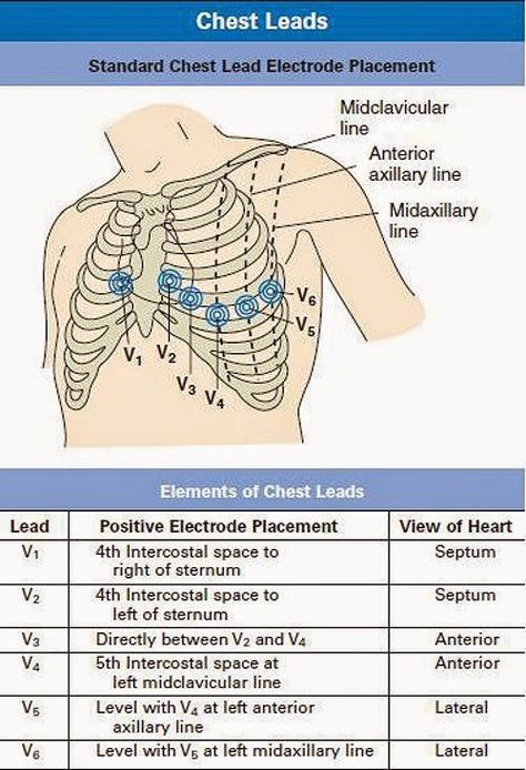 Standard chest lead electrode placement Ecg Reading, Ekg Interpretation, Heart Things, Paramedic School, Cardiac Nursing, Nursing School Survival, Critical Care Nursing, Nursing School Studying, Nursing School Tips