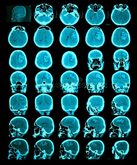 CT scan of the brain. Hemorrhagic stroke. Information for professionals royalty free stock photos Brain Scan Neuroscience, Ct Scan Brain, Psychology Posters, Bruce Nauman, Igcse Art, Brain Parts, Brain Scan, Medical Photos, Psychology Fun Facts