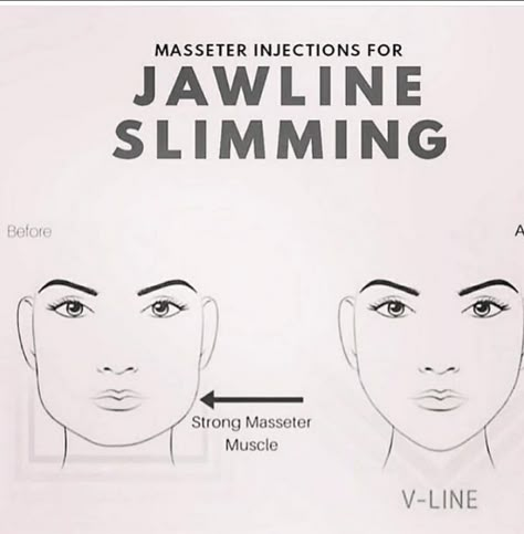 Strong masseter muscles may be the source of a square jawline; botox helps by targeting these muscles safely, providing a non-surgical way for a patient to reach their own personal aesthetic goals #botox #injectables #medicalaesthetics Botox Funny, For Jawline, Masseter Muscle, Square Jawline, Facial Esthetics, Botox And Fillers, Botox Before And After, Aesthetic Nurse, Nurse Injector