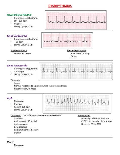 My Dysrhythmias study guide - DYSRHYTHMIAS Normal Sinus Rhythm P wave present (uniform) 60 – 100 bpm - Studocu Sinus Rhythm, Normal Sinus Rhythm, P Wave, Respiratory Therapy, Nursing School Tips, School Tips, School Hacks, Respiratory, Medical School