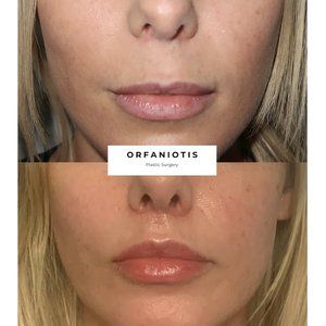 Lip Lift Before and After Gallery Lip Botox Before And After, Down Turned Lips, Lower Face Lift Before And After, Lip Lift Before And After, Blephoraplasty Before And After, Lip Flip Before And After, Lip Fillers Before And After, Subtle Lip Filler Before And After, Lip Injections Before And After