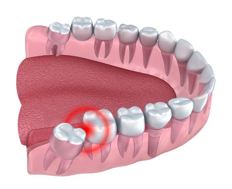 Wisdom Teeth Extraction, Wisdom Tooth Removal, Teeth Extraction, After Wisdom Teeth Removal, Tooth Extraction Aftercare, Tooth Extraction Healing, Dental Social Media, Wisdom Tooth, Wisdom Tooth Extraction