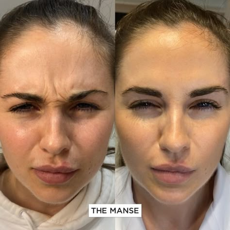 Deep Forehead Wrinkles, Derma Fillers, Botox Brow Lift, Botox Before And After, Face Surgery, Cheek Fillers, Wrinkle Filler, Instagram Face, Face Glow