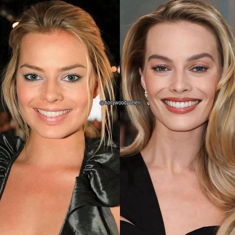 ➖ @rania.jalh #margotrobbie ♥️ Then and now Facial Fillers, Face Change, Celebrity Plastic Surgery, Margot Robbie, May 27, Facial Care, Radiant Skin, Plastic Surgery, Fashion Addict