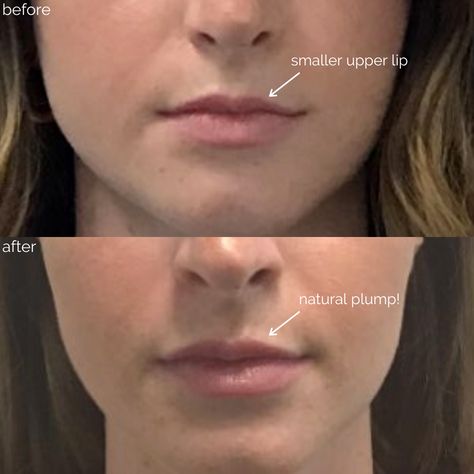 We have been getting a ton of DM's recently about people who want plump lips but don't want a drastic change. We can do just that! A small amount of filler can go a long way. Everyone will notice, no one will know.⠀⁠ ⠀⁠ 💤 Anesthesia: Topical⠀⁠ ⏳ Time it takes: 20-30 minutes⠀⁠ 📅 Recovery: 1-2 days mild swelling⠀⁠ 👍 Lasts: 6-12 Months⠀⁠ 😯 Pain level: Mild Mild Lip Filler, Lip Filler, Plump Lips, Lip Fillers, Lip Plumper, Dermatology, New Girl, 30 Minutes, Other People