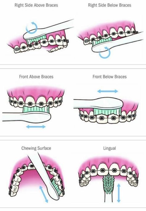 Dental Braces Colors, Braces Food, Cute Braces Colors, Braces Tips, Getting Braces, Haut Routine, Cute Braces, Kedokteran Gigi, Brace Face