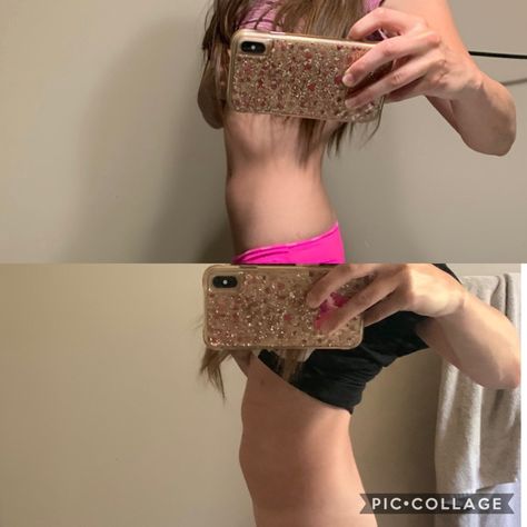 I was prescribed gonal f, menopur and cetrotide as daily injections for ivf. This is a before picture of what my stomach looked like before the shots and then a picture of my stomach the day before retrieval. I gained 6 pounds. Its been teo days since procedure and i am still feeling auper bloated but should go down soon! Gonal F, Egg Retrieval, Ivf Journey, My Pictures, Egg