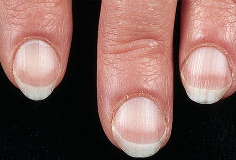 Clues about your health, from your fingernails. Interesting to know, Nail Symptoms, Fingernail Health, Nail Disorders, Pale Nails, Nail Problems, Nail Beds, Health Pictures, Brittle Nails, Nail Bed