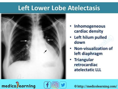 Chest X-ray interpretation Medical Radiography, Np School, Pet Ct, Radiology Technologist, Medical Pictures, Health And Physical Education, Pa School, Nursing School Studying, Heart And Lungs