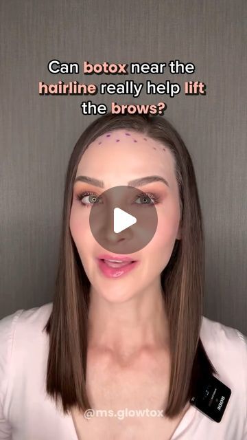 Rachel Jarrell ~ Houston Aesthetic Injector on Instagram: "SAVE THIS REEL for THIS CAPTION👇🏻

For those that have a strong downward pull near the hairline, injecting botox high on the forehead can help lift the brows

Especially because it’ll likely be combined with frown line botox… where most of the “Botox brow lift” comes from

Add the upper, outer eye muscles (under the tails of the brows) and you’ll maximize the lift even further 

At the least, injecting higher on the forehead can help maintain baseline brow position and reduce the risk of the brows dropping

However, placing Botox high on the forehead will not always smooth out lower forehead wrinkles, and in some cases can make the lower wrinkles more obvious🙃

BUT because botox in the frown line area helps lift the brows, we fi Botox For Hooded Eyes, Brow Lift Botox Eyebrows, Botox Brow Lift Before And After, Botox Eyebrow Lift, Botox Under Eyes, Houston Aesthetic, Botox Forehead, Aesthetic Injector, Eye Muscles