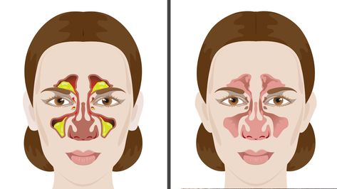 Getting a cold or allergy means dealing with some annoying symptoms such as being congested. Here are 5 simple ways to remove mucus and phlegm naturally.. Getting Rid Of Mucus, Remedy For Sinus Congestion, Mucus Relief, Getting Rid Of Phlegm, Home Remedies For Sinus, Sinus Congestion Relief, Best Cough Remedy, Cold Or Allergies, Congestion Relief